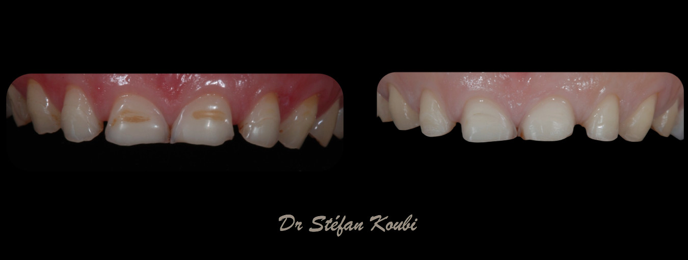 veneers and crowns /Dr Stefan Koubi